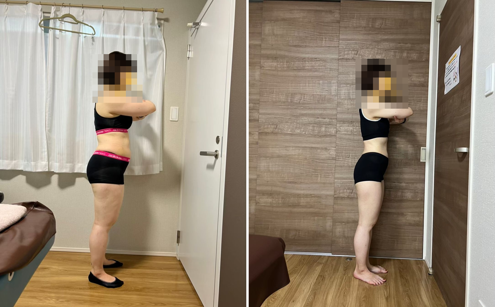 40代女性の側面ビフォーアフター（顔はモザイク処理）